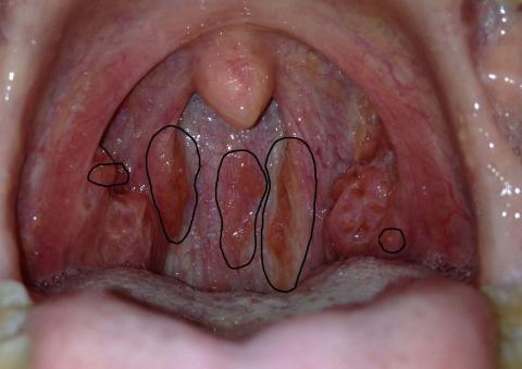 Hrdlo - herpes ?